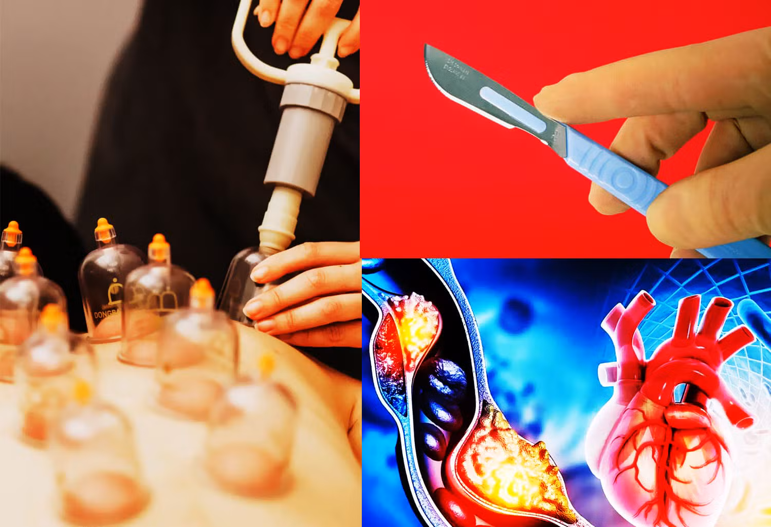 Rahasia Sains di Balik Hadis Bekam, Studi Ilmiah tentang Teknik Goresan Bekam 0,9 Milimeter 