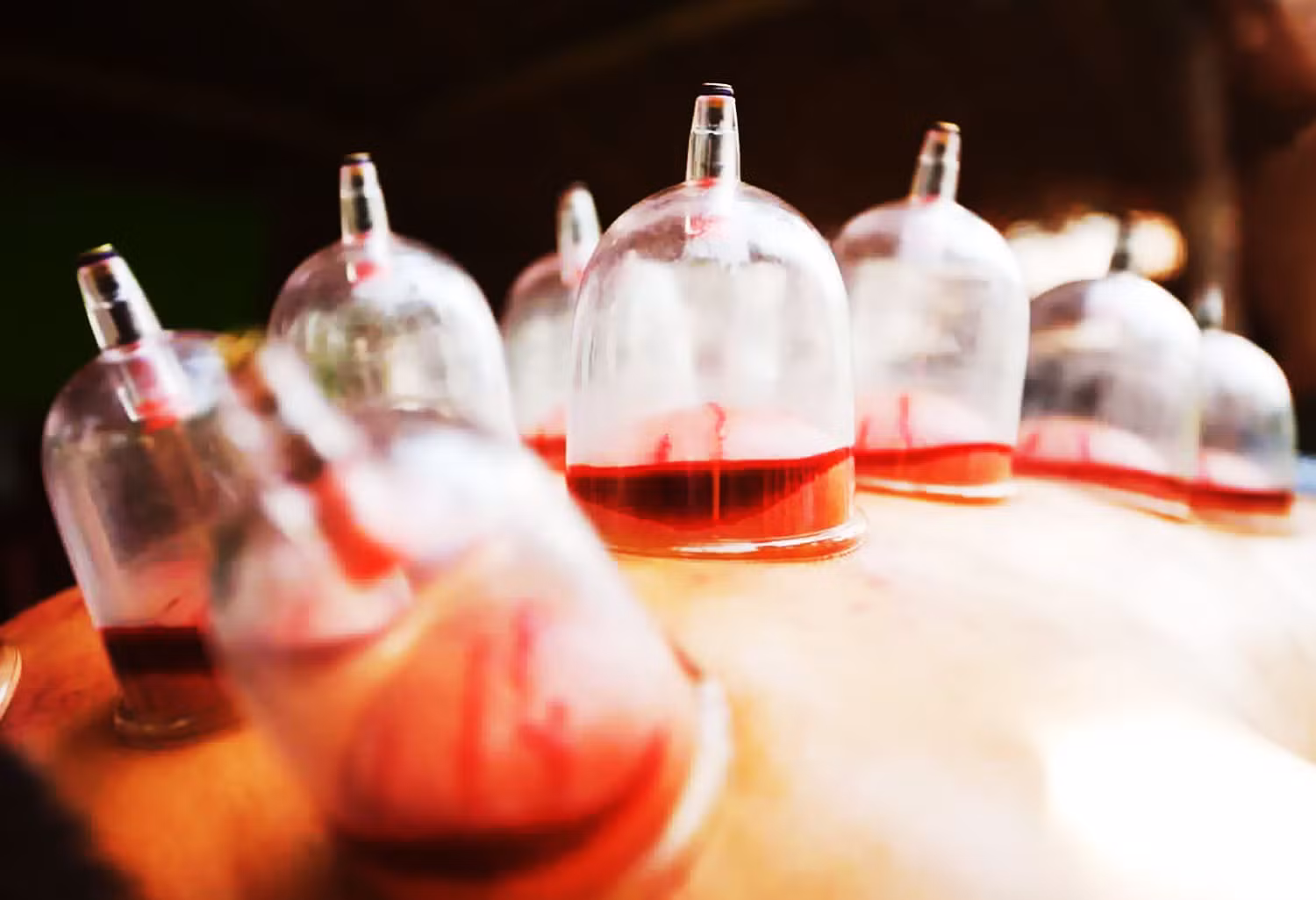 Wet Cupping Accelerates Pregnancy Study in Saudi Arabia Records 20 Percent of Patients Pregnant After Cupping