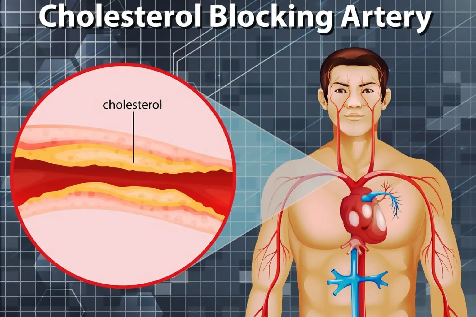 Penelitian Ilmiah Ungkap Bekam Goresan Hilangkan Nyeri Tengkuk dan Kesemutan Penderita Kolesterol 