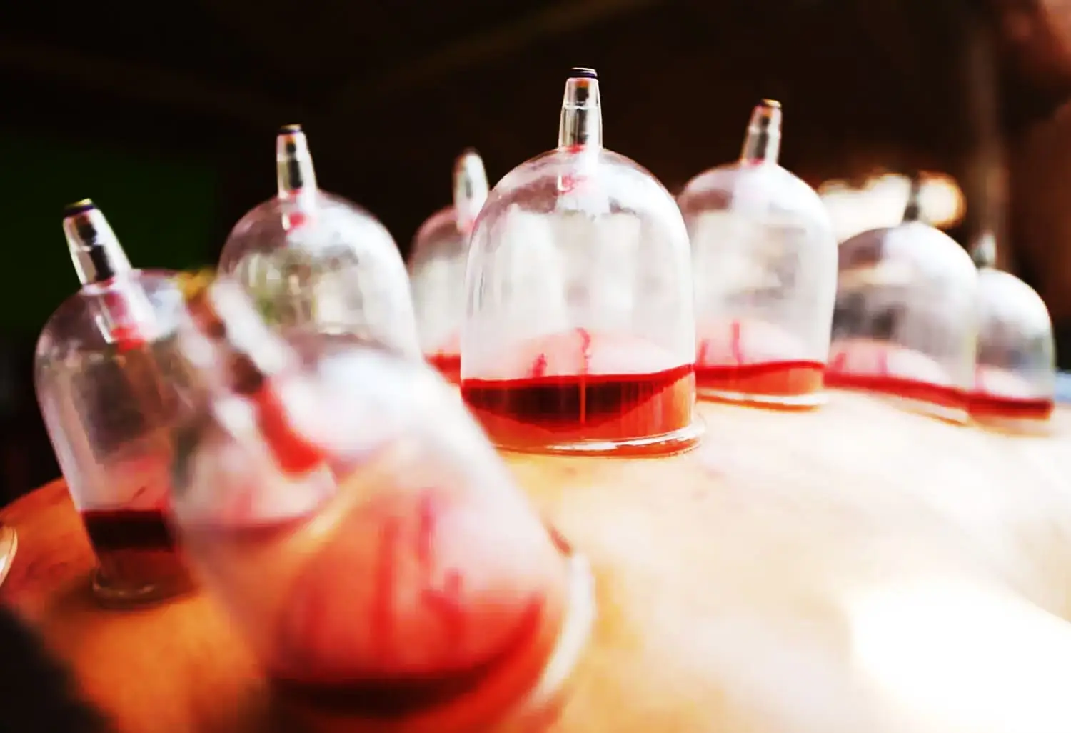 Wet Cupping Accelerates Pregnancy Study in Saudi Arabia Records 20 Percent of Patients Pregnant After Cupping