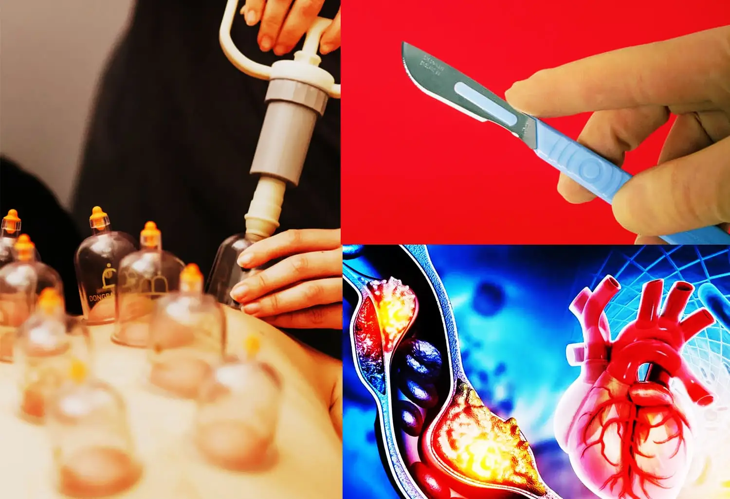 Rahasia Sains di Balik Hadis Bekam, Studi Ilmiah tentang Teknik Goresan Bekam 0,9 Milimeter 